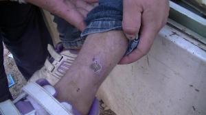 sarna en Los Cerrillos